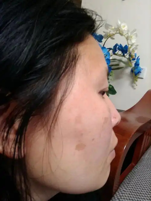 才30多岁脸上就长这种斑? 这是什么斑?能治么