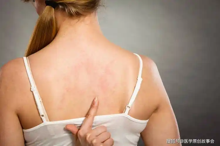 30岁女子浑身瘙痒,确诊淋巴瘤,提醒:2处发痒,可能是癌症预警_皮肤