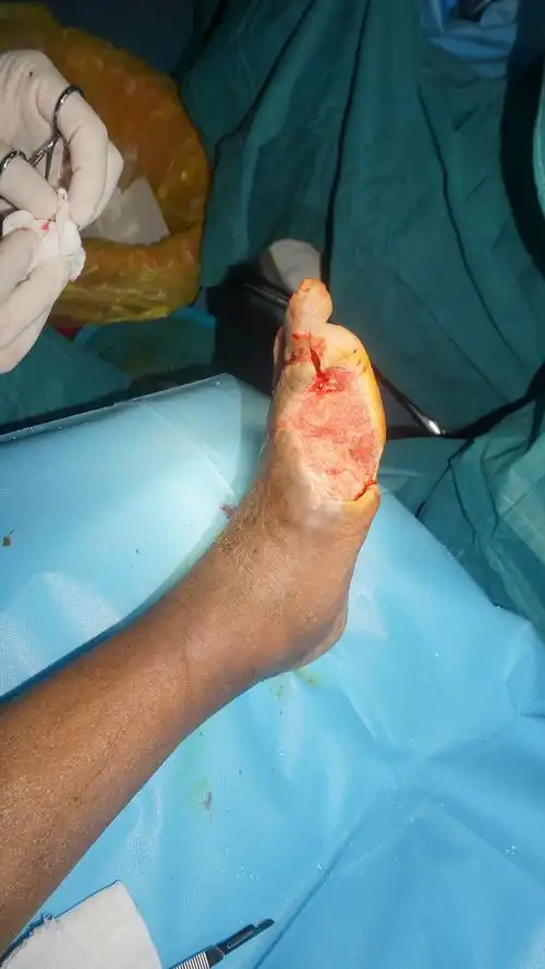 彻底清创,留下创面经过换药后愈合