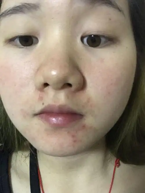 下巴处一直皮肤都这样不好,还脱皮,脸部皮肤也变得好差,是什么原因呢