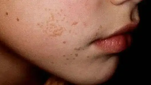 一次性烧掉几百颗扁平疣连医生都不忍心再收费