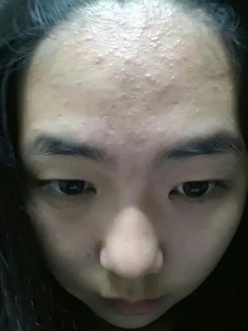额头上这个是扁平疣吗 鼻梁上也有好几个红点