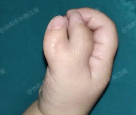 畸形|肌腱|关节囊|人工膝关节_网易订阅