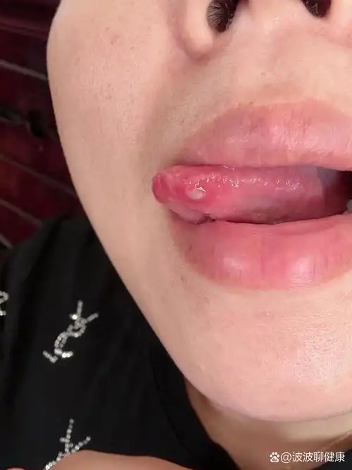 舌头溃疡