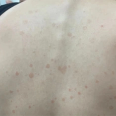 花斑癣的临床表现马拉色菌的免疫荧光镜检和koh直接镜检花斑癣顾名思