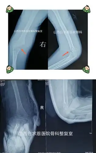 女孩,6岁,右肱骨髁上骨折