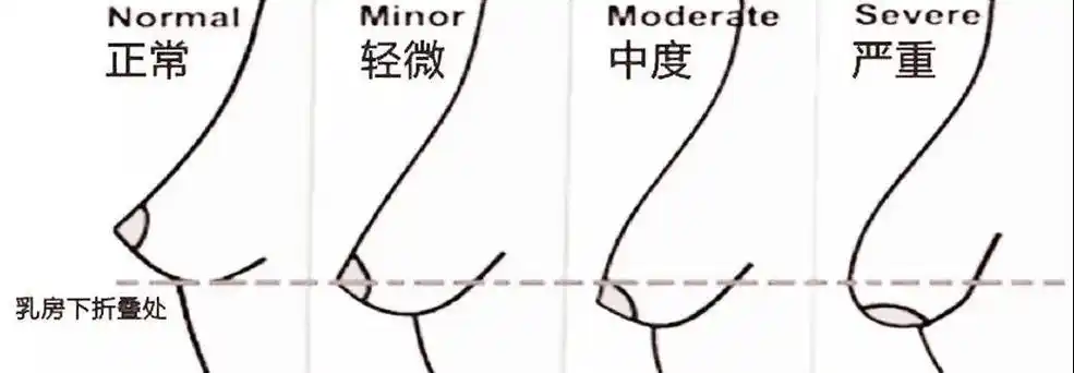 一般来说,正常体积乳房约250~350ml,当乳房体积超过正常的乳房体积的