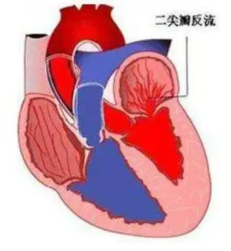 二尖瓣关闭不全.png