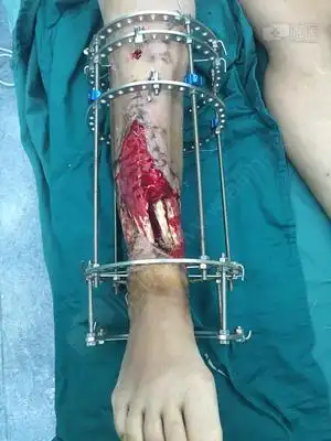 ilizarov技术修复胫骨骨缺损