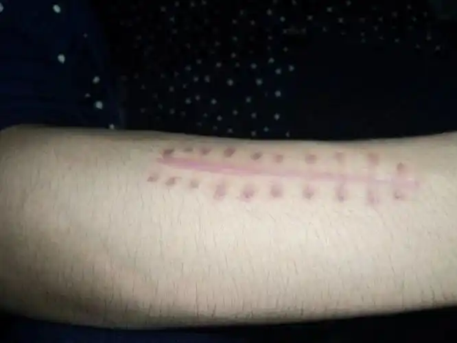 手上有一条疤可不可以去当兵?