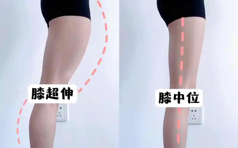 0成本改善膝超伸97我腿真的直了6015