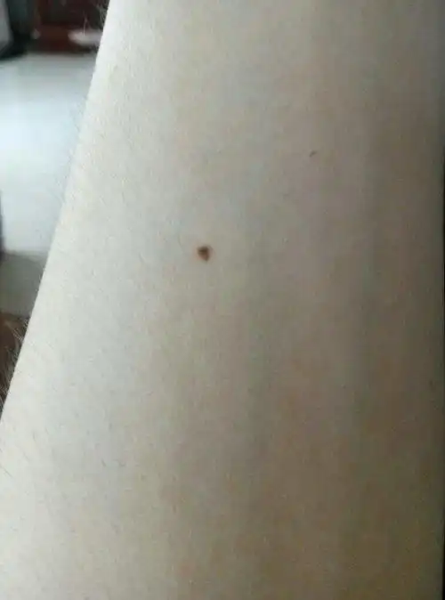 人皮肤上的这种黑点叫什么?