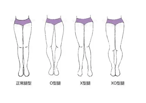 先天的o型腿,真的能矫正吗?