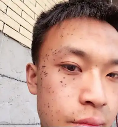 脸上黑斑 (12)_有来医生