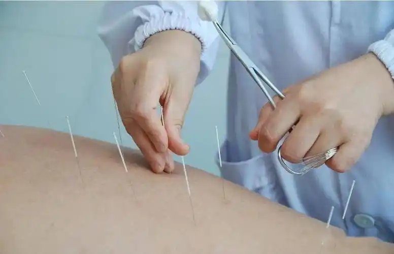 "通督启神"针法 背俞穴 "靳三针",高效治抑郁