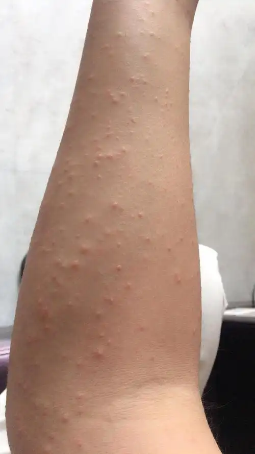 一个礼拜全身都是湿疹,该怎么办