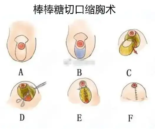 切口是一个围绕乳晕的圆圈,在乳晕下面加一个垂直的切口缩小乳房