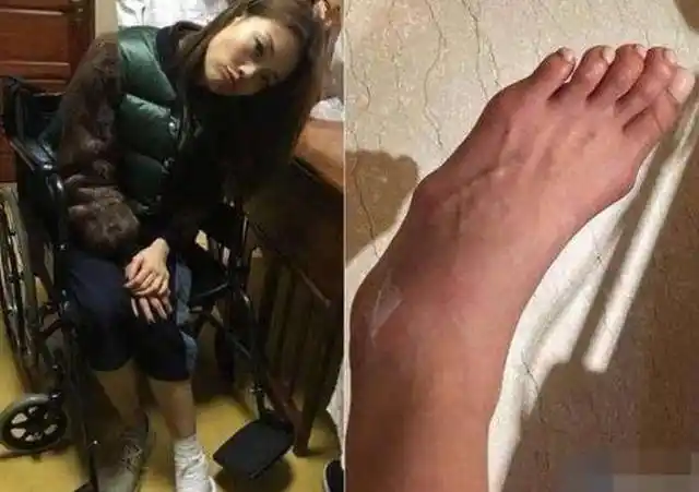 杨紫琼因为穿高跟鞋而导致的拇指外翻,也是十分吓人的!