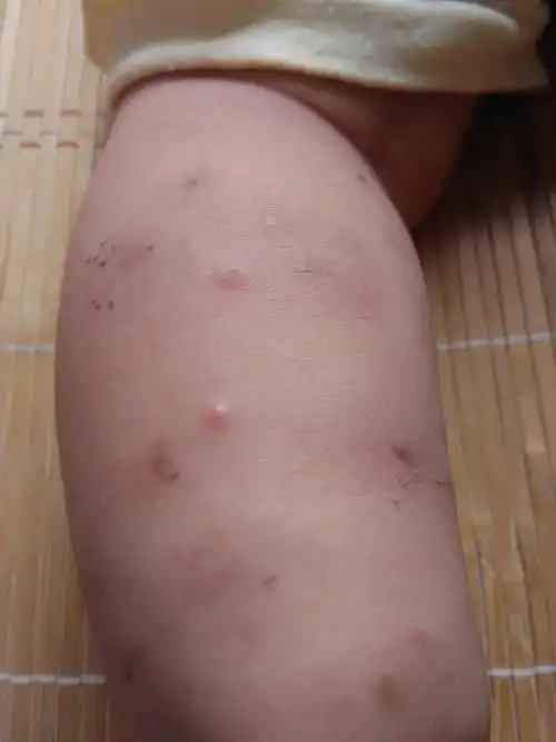 我家宝宝八个月,得了丘疹性荨麻疹,拿的药摸,有的都快好了,怎么今天