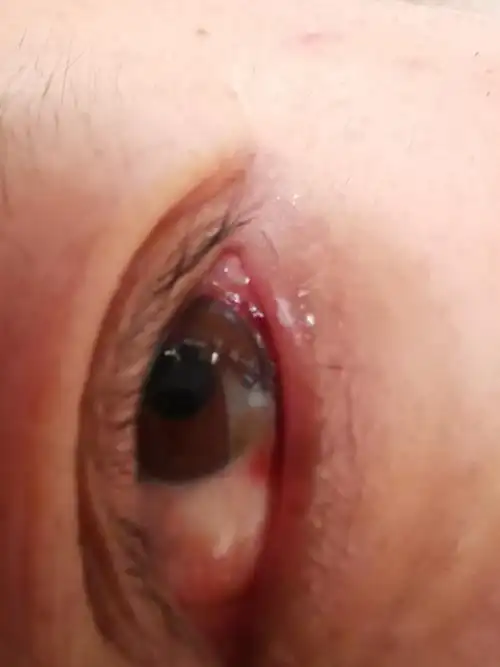 肺腺癌晚期,阿法替尼服用一个月,眼睛干痒有红血块.求处理办法谢谢