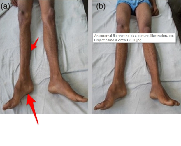 偏侧萎缩症(hemiatrophy)_肌病_症状_治疗方法_症状表现_治疗方式