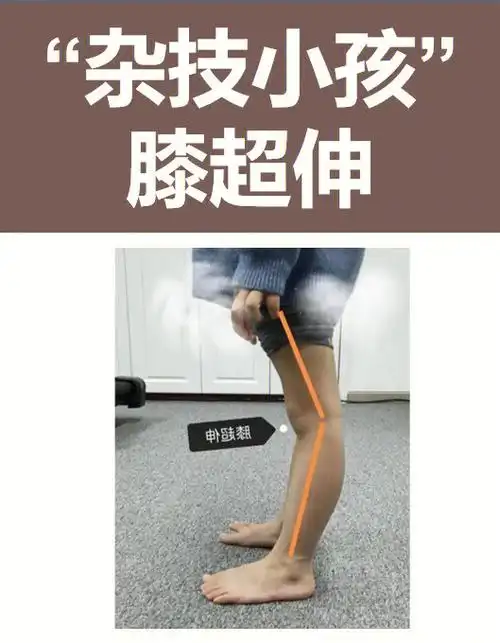 杂技小孩膝超伸