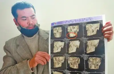 通过ct片能明显看出下颌骨断裂