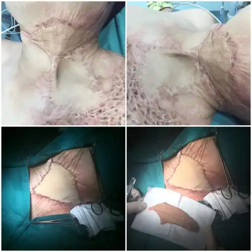 瘢痕挛缩(植皮术) - 好大夫在线