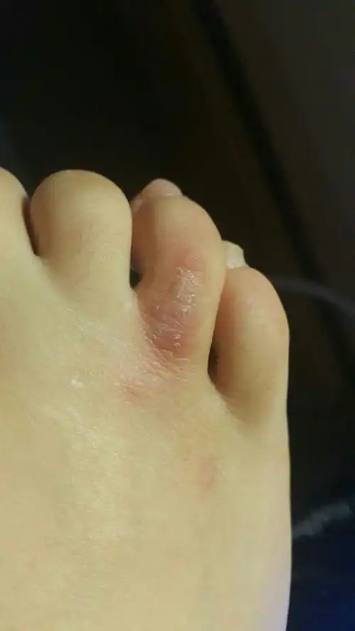 我这脚上的是啥 是藓吗?怎么搞啊 多谢!