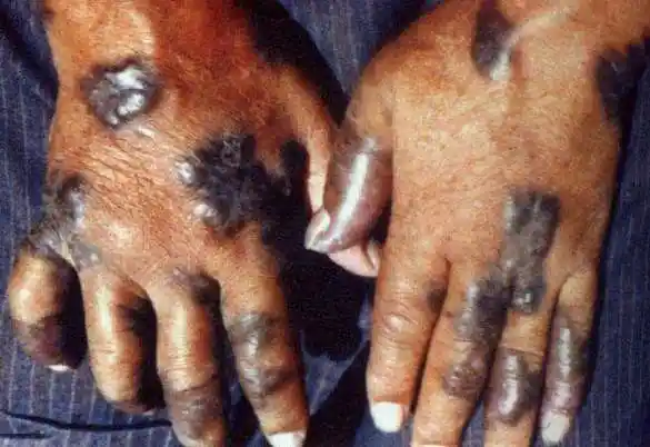 艾滋病皮疹及图片