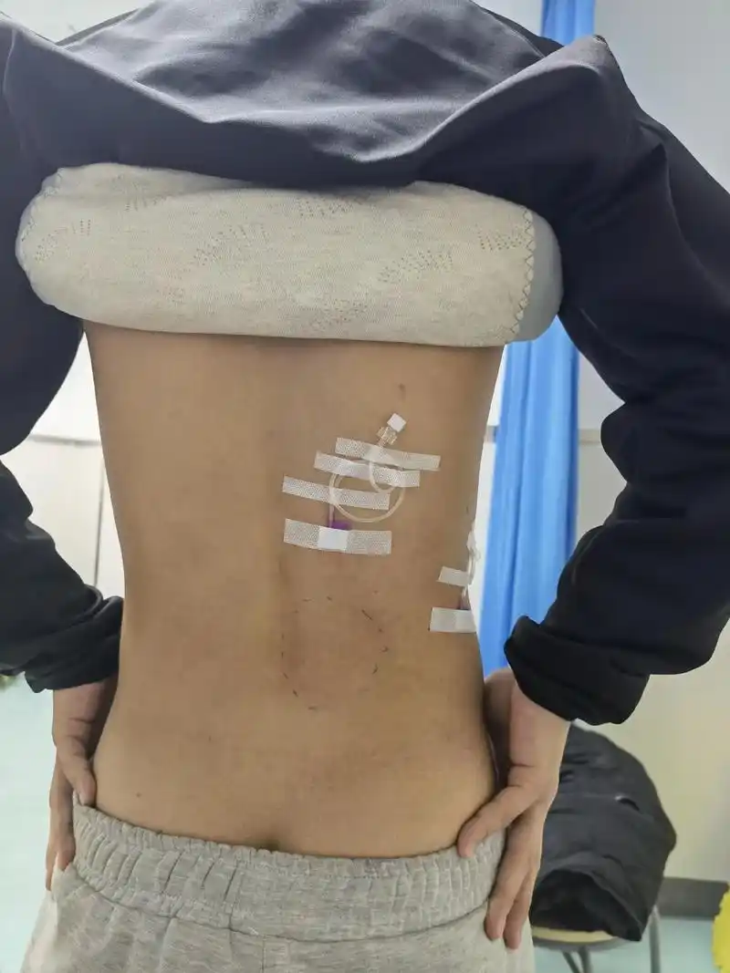 腰扭伤 #皮内针  体育生,腰扭伤一个星期,针前不敢弯腰, - 抖音