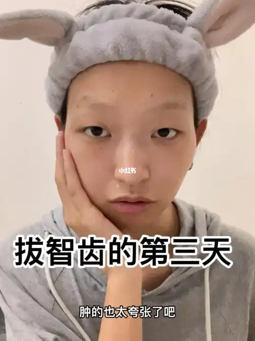 牙套日记拔完智齿肿成了一个大包子60