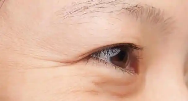 可能会随着年龄,环境,生活方式改变,加剧了眼下细纹,皱纹的生成