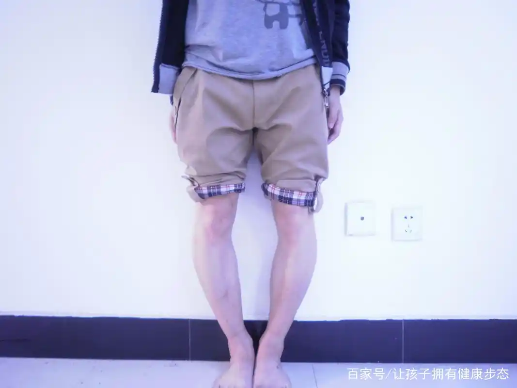 o型腿如何炼成铅笔腿?