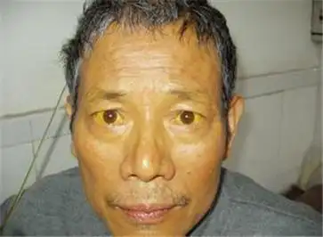 酒精肝的患者会出现哪些症状