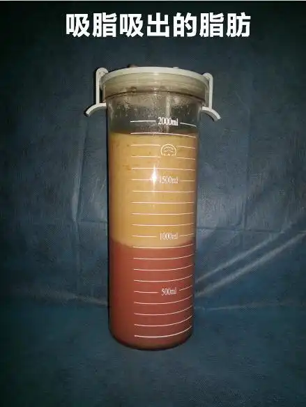 运动,节食等各种减肥方法我就不说了,带大家认识一下吸脂出来的脂肪吧