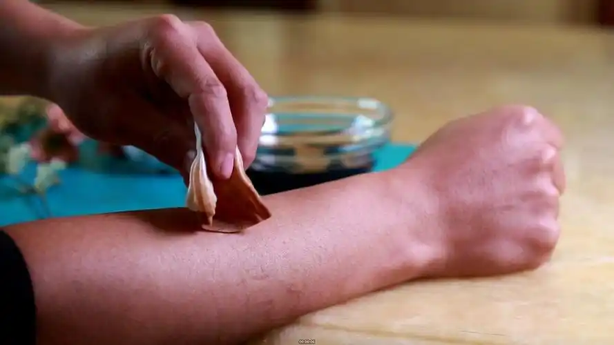 过敏皮炎湿疹擦药偏方