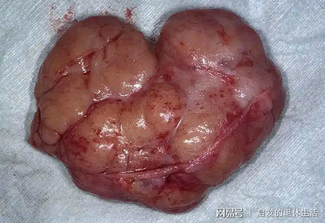 恶性肿瘤的三个特征良性肿瘤和恶性肿瘤的区别