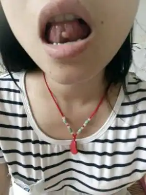 孕中期,舌头下面起了个泡,一个星期了,不会消,也