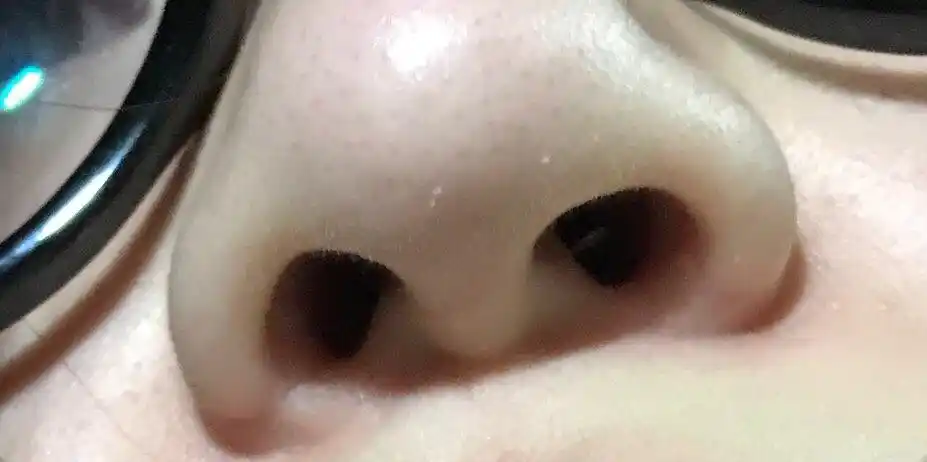 想问一下,隆鼻半年后,鼻子鼻尖发白,鼻子硬,是必须要取出假体吗?