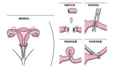 图解让女性去做结扎到底是有多受罪过来人的经验告诉你