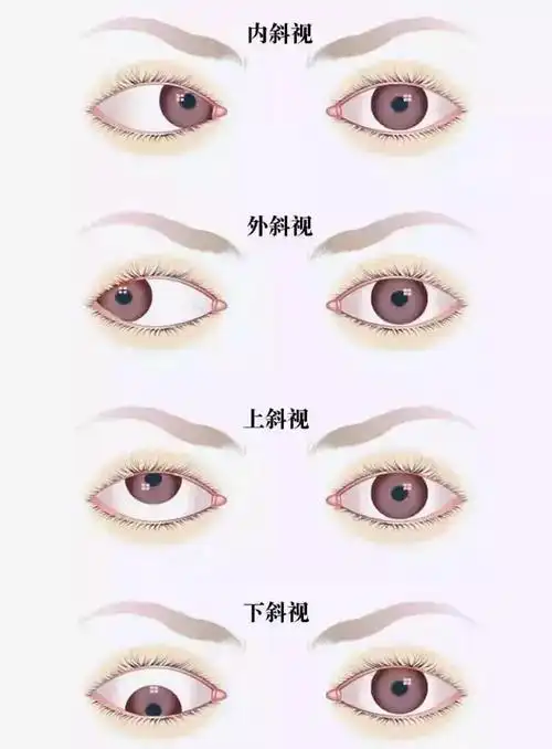 孩子眼睛斜不一定就是斜视家庭自测小妙招奉上