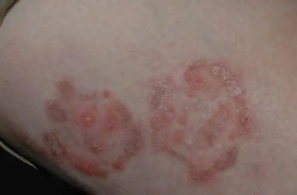 体癣药物微波渗透疗法中西药结合缓步推进