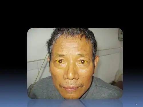 黄疸的诊断思路ppt参考课件