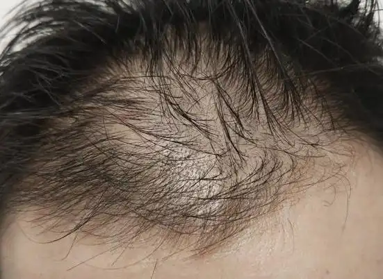 发质偏油性,干燥,稀疏,容易塌的男生适合用什么洗发水?