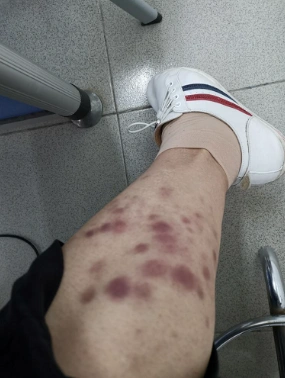 缓解时小腿出痧情况