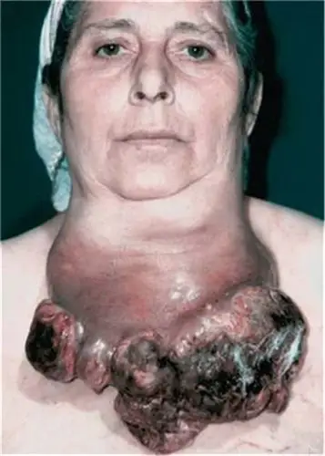 东区肿瘤专家_东区治疗肿瘤哪个专家好_东区治疗肿瘤最好的专家/排行