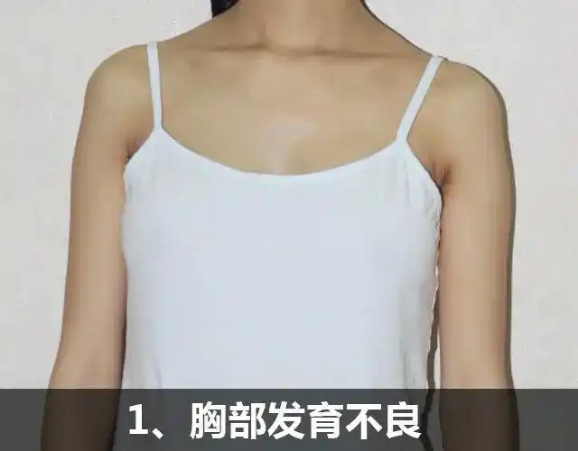 资料统计显示,青春期发育不良的女性占想要隆胸女性群体的35%(数据