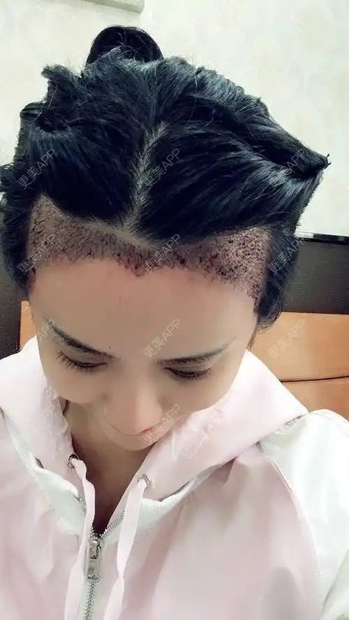 1344的植发际线日记