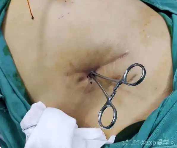 阑尾炎手术切口换药后腹壁小肠瘘